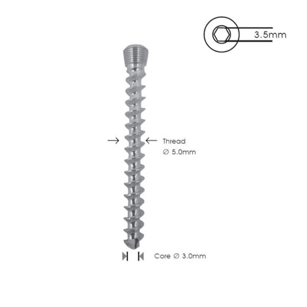 Tornillo-de-Bloqueo-de-Esponjosa-5.0-mm-TR-01.jpg Tornillo de Bloqueo de Esponjosa 5.0 mm TR